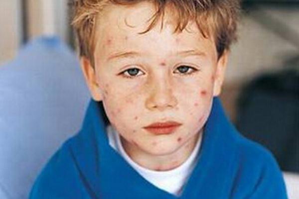 水痘一般第幾天停止長(zhǎng) 水痘一般多久可以痊愈 水痘一般第幾天停止長(zhǎng) 水痘一般多久可以痊愈