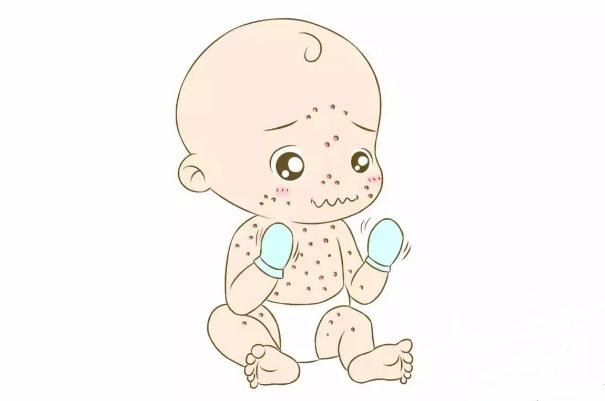 水痘會(huì)傳染給大人嗎 水痘會(huì)傳染給嬰兒嗎
