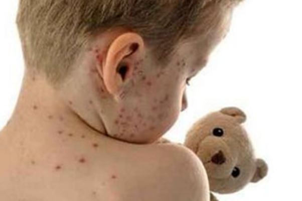 水痘初期癥狀 水痘多久能好 水痘初期癥狀 水痘多久能好