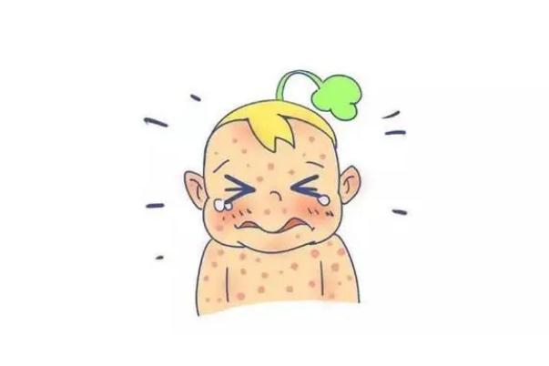 水痘的潛伏期會(huì)傳染嗎 水痘的傳播途徑 水痘的潛伏期會(huì)傳染嗎 水痘的傳播途徑