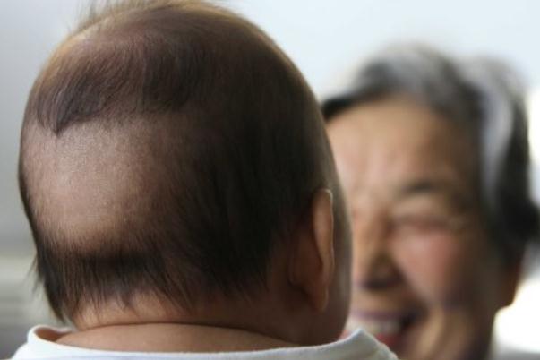 嬰兒枕禿要怎么辦 嬰兒枕禿要補(bǔ)鈣嗎 嬰兒枕禿要怎么辦 嬰兒枕禿要補(bǔ)鈣嗎