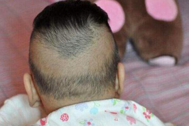 嬰兒枕禿是缺鈣嗎 嬰兒枕禿補什么鈣 嬰兒枕禿是缺鈣嗎 嬰兒枕禿補什么鈣
