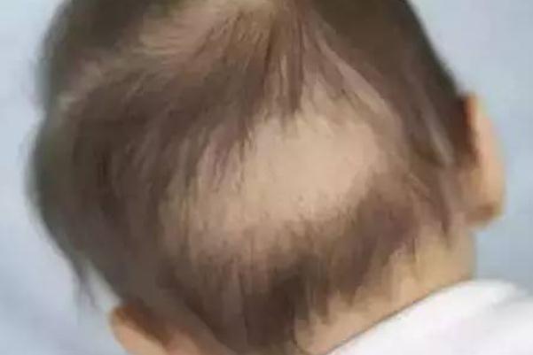 嬰兒枕禿是什么原因引起的 嬰兒枕禿什么時(shí)候能好 嬰兒枕禿是什么原因引起的 嬰兒枕禿什么時(shí)候能好