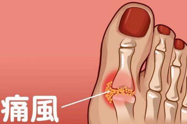 痛風吃什么藥快速消腫止痛 痛風如何簡單預(yù)防 痛風吃什么藥快速消腫止痛 痛風如何簡單預(yù)防