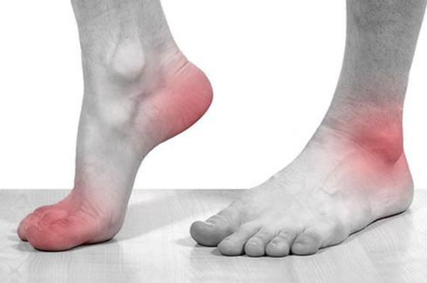 痛風是什么原因引起的 痛風有哪些癥狀 痛風是什么原因引起的 痛風有哪些癥狀