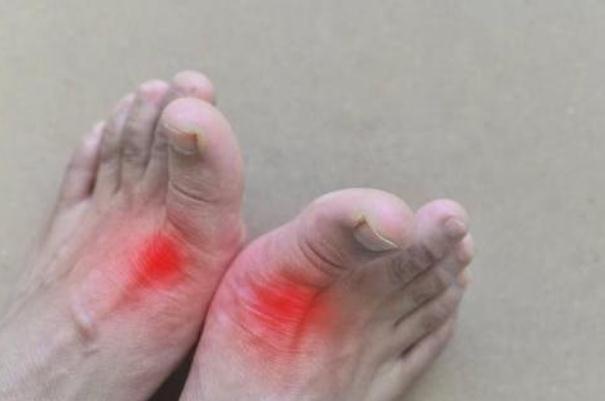 痛風(fēng)的早期癥狀是什么 痛風(fēng)的前兆是什么癥狀 痛風(fēng)的早期癥狀是什么 痛風(fēng)的前兆是什么癥狀