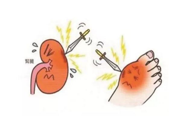 痛風(fēng)要怎么才能徹底治好 痛風(fēng)要看什么科室 痛風(fēng)要怎么才能徹底治好 痛風(fēng)要看什么科室