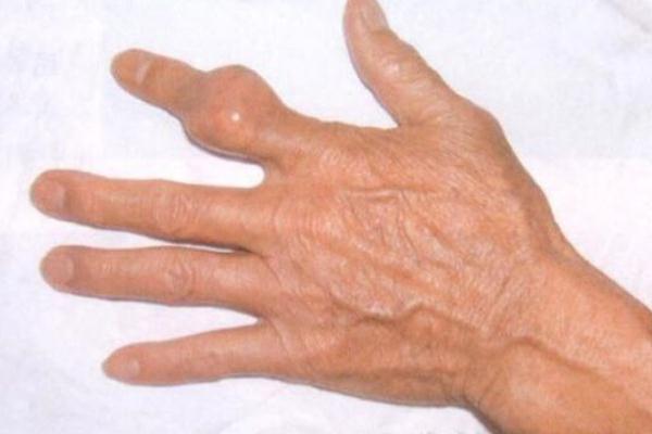 痛風是什么原因引起的 痛風有哪些癥狀 痛風是什么原因引起的 痛風有哪些癥狀