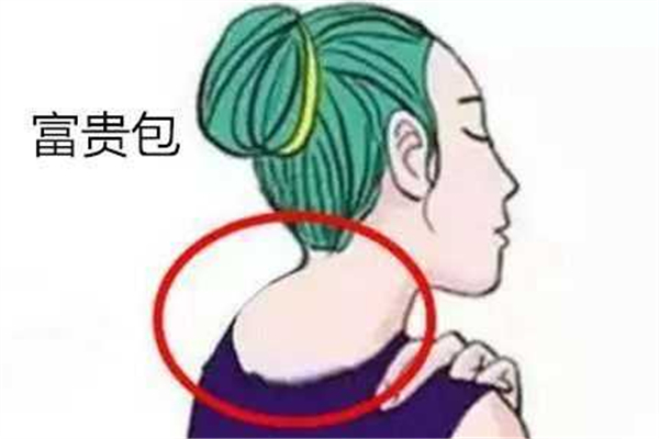 富貴包有什么癥狀 富貴包有幾種類型 富貴包有什么癥狀 富貴包有幾種類型