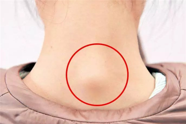 富貴包會引起耳鳴嗎 富貴包會引起腦供血不足嗎 富貴包會引起耳鳴嗎 富貴包會引起腦供血不足嗎