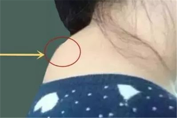 富貴包是什么原因引起的 富貴包可以抽脂消除嗎 富貴包是什么原因引起的 富貴包可以抽脂消除嗎