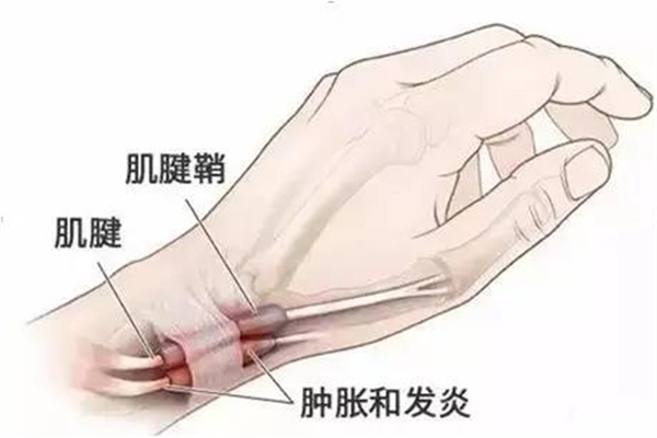 腱鞘炎都在什么部位的 腱鞘炎會(huì)導(dǎo)致手指腫脹嗎 腱鞘炎都在什么部位的 腱鞘炎會(huì)導(dǎo)致手指腫脹嗎