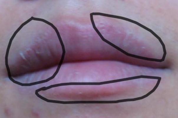 唇炎的癥狀有哪些 唇炎的治療方法 唇炎的癥狀有哪些 唇炎的治療方法