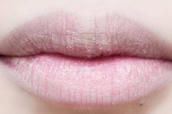 唇炎有什么忌口 唇炎有黃痂要去掉還是留著 唇炎有什么忌口 唇炎有黃痂要去掉還是留著