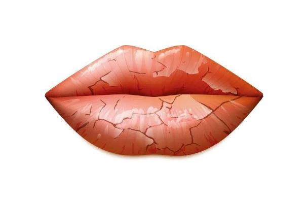 唇炎有什么忌口 唇炎有黃痂要去掉還是留著 唇炎有什么忌口 唇炎有黃痂要去掉還是留著