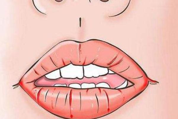 唇炎吃什么維生素 唇炎怎么能徹底治療好 唇炎吃什么維生素 唇炎怎么能徹底治療好