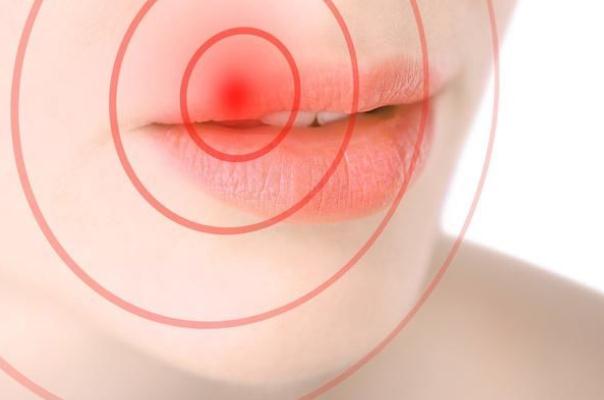 唇炎可以涂潤唇膏嗎 唇炎可以涂凡士林嗎 唇炎可以涂潤唇膏嗎 唇炎可以涂凡士林嗎