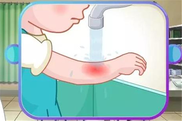 燙傷之后有疤痕可以徹底恢復(fù)嗎 燙傷有疤痕怎么去掉 燙傷之后有疤痕可以徹底恢復(fù)嗎 燙傷有疤痕怎么去掉