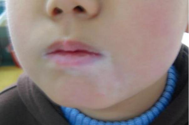 孩子臉上有白斑 孩子臉上有白斑是不是肚子有蟲呢 孩子臉上有白斑 孩子臉上有白斑是不是肚子有蟲呢
