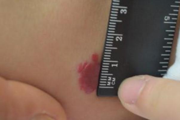 新生兒血管瘤能消退嗎 新生兒血管瘤治療費(fèi)用大概多少 新生兒血管瘤能消退嗎 新生兒血管瘤治療費(fèi)用大概多少