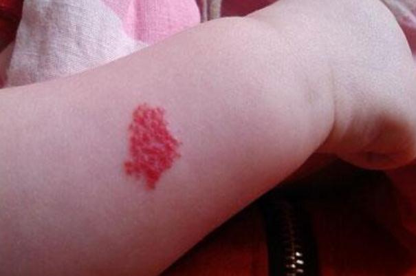 新生兒血管瘤多久消退 新生兒血管瘤什么時(shí)候治療最好 新生兒血管瘤多久消退 新生兒血管瘤什么時(shí)候治療最好