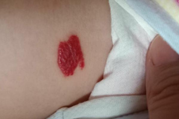 新生兒血管瘤多久消退 新生兒血管瘤什么時(shí)候治療最好 新生兒血管瘤多久消退 新生兒血管瘤什么時(shí)候治療最好