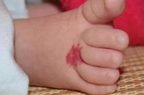 新生兒血管瘤多久消退 新生兒血管瘤什么時(shí)候治療最好 新生兒血管瘤多久消退 新生兒血管瘤什么時(shí)候治療最好