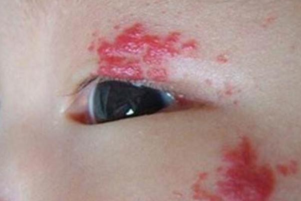 新生兒血管瘤的形成原因 新生兒血管瘤是很嚴(yán)重的病嗎 新生兒血管瘤的形成原因 新生兒血管瘤是很嚴(yán)重的病嗎