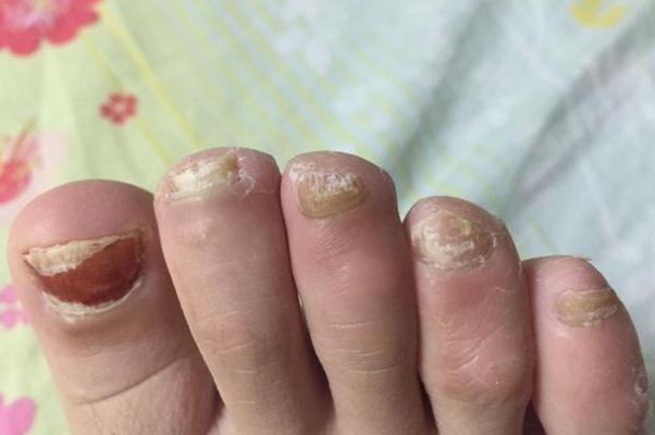 灰指甲怎么才能根治 灰指甲的克星 灰指甲怎么才能根治 灰指甲的克星