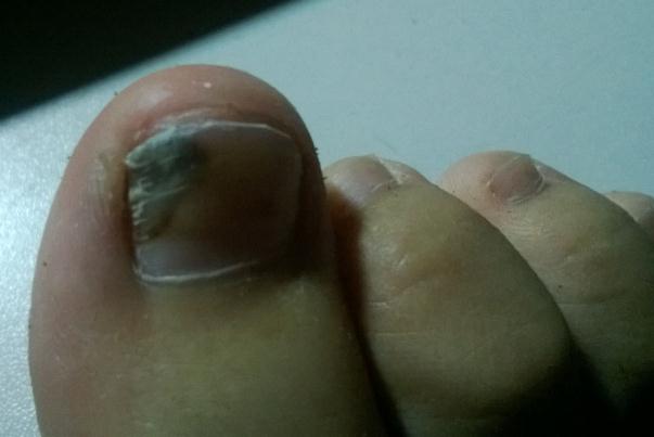 灰指甲會(huì)不會(huì)傳染別人 灰指甲會(huì)疼痛嗎 灰指甲會(huì)不會(huì)傳染別人 灰指甲會(huì)疼痛嗎