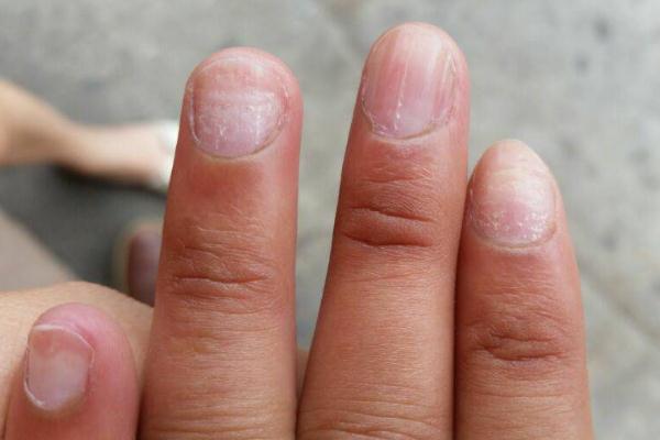 灰指甲有異味嗎 灰指甲有沒有傳染性 灰指甲有異味嗎 灰指甲有沒有傳染性