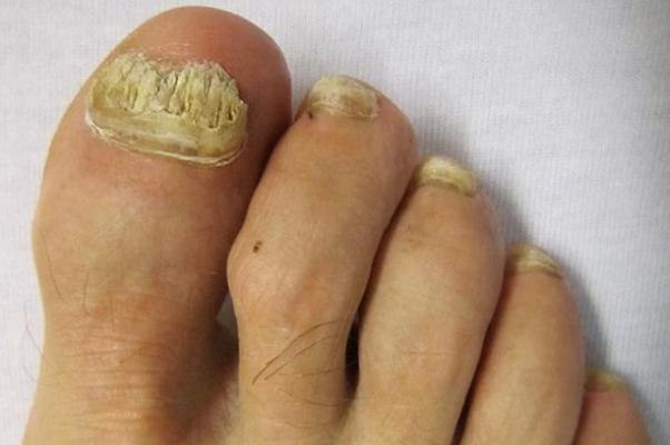 灰指甲是怎么引起的 灰指甲早期癥狀 灰指甲是怎么引起的 灰指甲早期癥狀