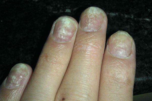 灰指甲是怎么引起的 灰指甲早期癥狀 灰指甲是怎么引起的 灰指甲早期癥狀