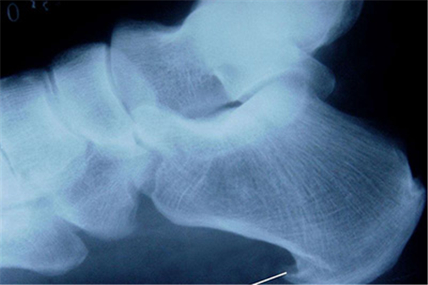 骨質(zhì)增生是缺鈣嗎 骨質(zhì)增生是缺什么營(yíng)養(yǎng)嗎 骨質(zhì)增生是缺鈣嗎 骨質(zhì)增生是缺什么營(yíng)養(yǎng)嗎