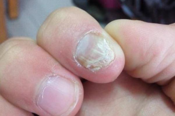 灰指甲的危害性有哪些 灰指甲是怎么引起的 灰指甲的危害性有哪些 灰指甲是怎么引起的