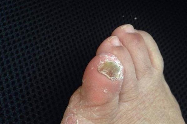 灰指甲怎么才能根治 灰指甲的克星 灰指甲怎么才能根治 灰指甲的克星