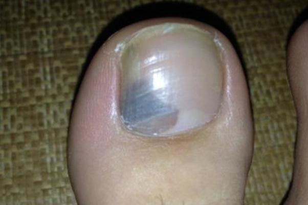 灰指甲怎么才能根治 灰指甲的克星 灰指甲怎么才能根治 灰指甲的克星