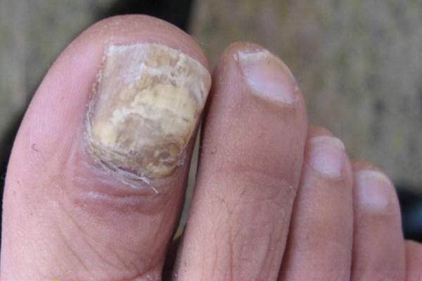 灰指甲是怎么引起的 灰指甲早期癥狀 灰指甲是怎么引起的 灰指甲早期癥狀