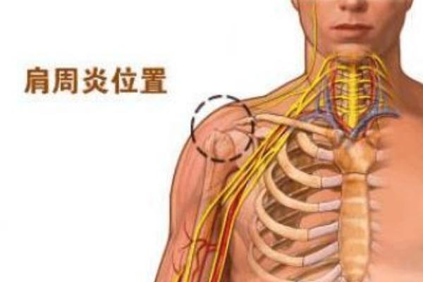 肩周炎怎么治療最快最好方法 肩周炎的癥狀表現(xiàn) 肩周炎怎么治療最快最好方法 肩周炎的癥狀表現(xiàn)