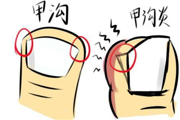 甲溝炎要拔掉整個(gè)指甲嗎 甲溝炎指甲拔了還能在長(zhǎng)出來嗎 甲溝炎要拔掉整個(gè)指甲嗎 甲溝炎指甲拔了還能在長(zhǎng)出來嗎