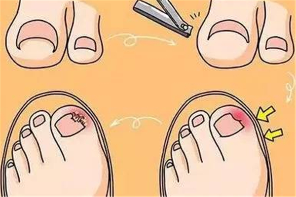 甲溝炎會長手上嗎 手上的甲溝炎怎么處理 甲溝炎會長手上嗎 手上的甲溝炎怎么處理