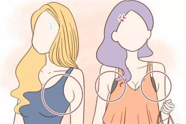 副乳是什么形成的 副乳對身體有什么影響嗎 副乳是什么形成的 副乳對身體有什么影響嗎