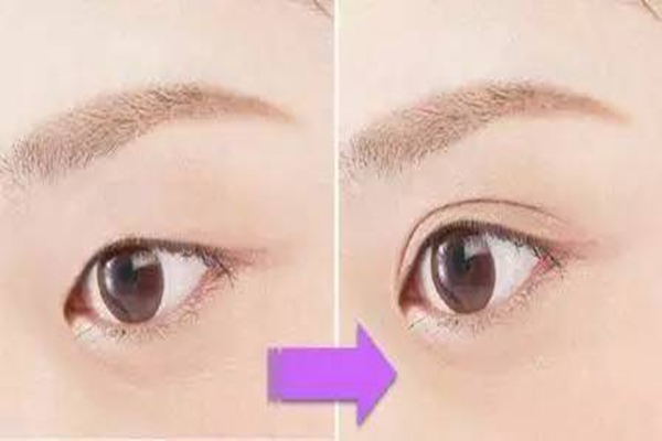 雙眼皮手術(shù)多久能恢復(fù)自然 雙眼皮手術(shù)多少錢一次 雙眼皮手術(shù)多久能恢復(fù)自然 雙眼皮手術(shù)多少錢一次