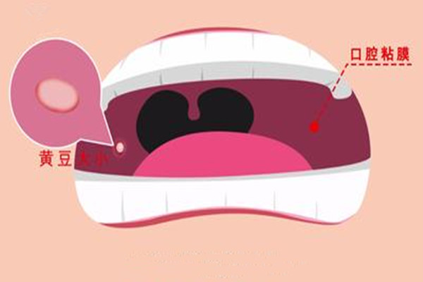 口腔潰瘍會引起口臭嗎 口腔潰瘍會引起口腔癌嗎 口腔潰瘍會引起口臭嗎 口腔潰瘍會引起口腔癌嗎