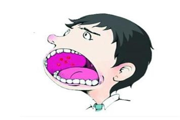 口腔潰瘍具有傳染性嗎 口腔潰瘍具有遺傳性嗎 口腔潰瘍具有傳染性嗎 口腔潰瘍具有遺傳性嗎