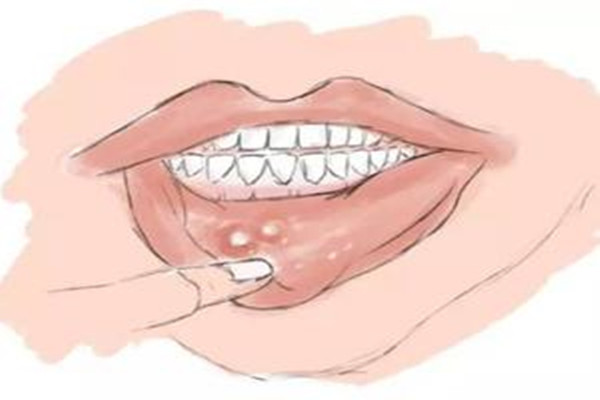 口腔潰瘍會(huì)導(dǎo)致臉腫嗎 口腔潰瘍會(huì)導(dǎo)致喉嚨痛嗎 口腔潰瘍會(huì)導(dǎo)致臉腫嗎 口腔潰瘍會(huì)導(dǎo)致喉嚨痛嗎