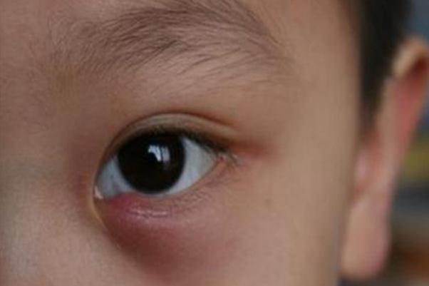 寶寶眼睛長了麥粒腫怎么辦 寶寶長麥粒腫的原因 寶寶眼睛長了麥粒腫怎么辦 寶寶長麥粒腫的原因