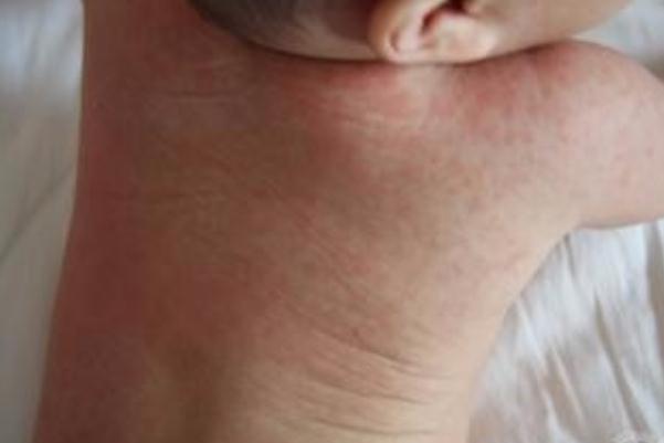 寶寶長(zhǎng)痱子有點(diǎn)化膿了怎么辦 寶寶長(zhǎng)痱子會(huì)癢嗎 寶寶長(zhǎng)痱子有點(diǎn)化膿了怎么辦 寶寶長(zhǎng)痱子會(huì)癢嗎