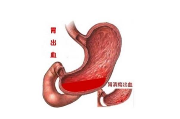 胃出血有什么癥狀表現(xiàn) 胃出血后吃什么補血又養(yǎng)胃 胃出血有什么癥狀表現(xiàn) 胃出血后吃什么補血又養(yǎng)胃