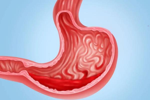 胃出血有什么癥狀表現(xiàn) 胃出血后吃什么補血又養(yǎng)胃 胃出血有什么癥狀表現(xiàn) 胃出血后吃什么補血又養(yǎng)胃